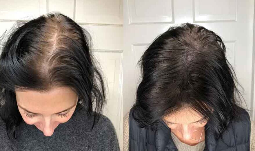 Why Scalp Micropigmentation is Gaining Traction in the Beauty Industry