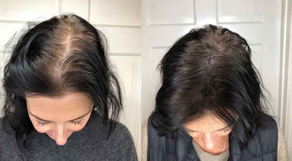Why Scalp Micropigmentation is Gaining Traction in the Beauty Industry