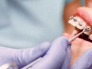 The Role of Orthodontics in Preventing Long-Term Dental Problems in North Vancouver