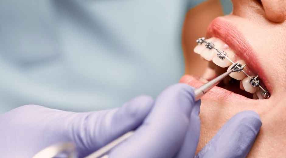 The Role of Orthodontics in Preventing Long-Term Dental Problems in North Vancouver