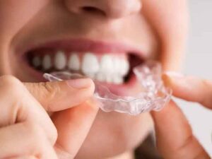 Braces for Adults: Why It's Never Too Late for a Straight Smile
