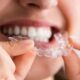 Braces for Adults: Why It's Never Too Late for a Straight Smile