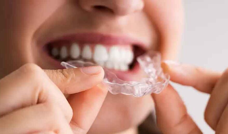 Braces for Adults: Why It's Never Too Late for a Straight Smile