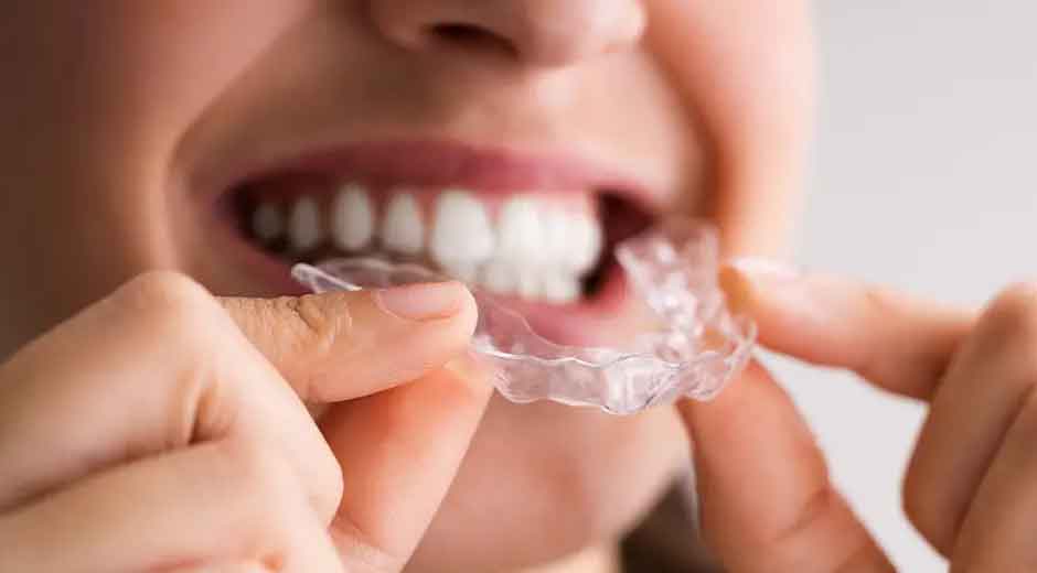 Braces for Adults: Why It's Never Too Late for a Straight Smile